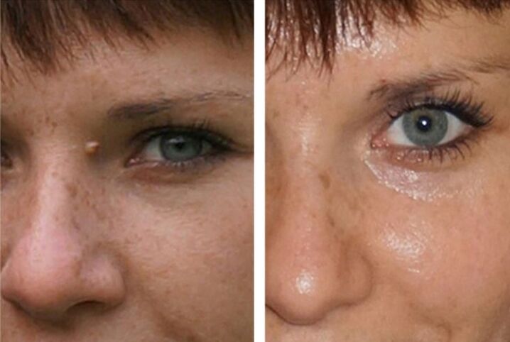 antes e depois da remoção do papiloma a laser photo 1