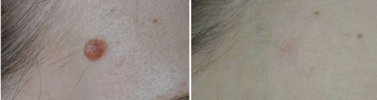antes e depois da remoção do papiloma a laser photo 2