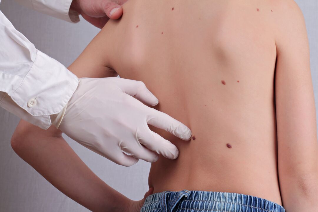 Um dermatologista realiza um exame clínico de um paciente com papilomas no corpo