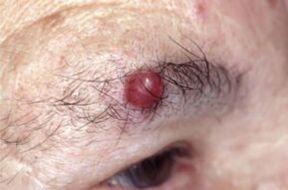 Papilloma nas sobrancelhas