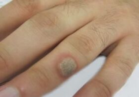 Papilloma no pincel