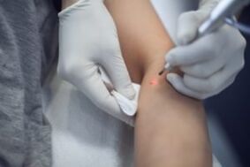 Tratamento a laser