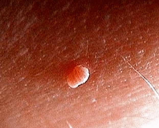 Papilloma no corpo