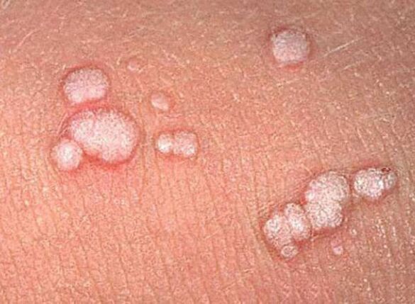 Papillomas no corpo humano