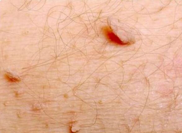 Papilomas afiados no corpo humano
