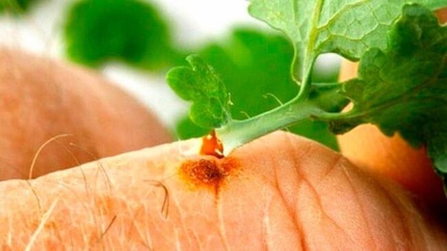Aplicando suco de celidônia em uma verruga