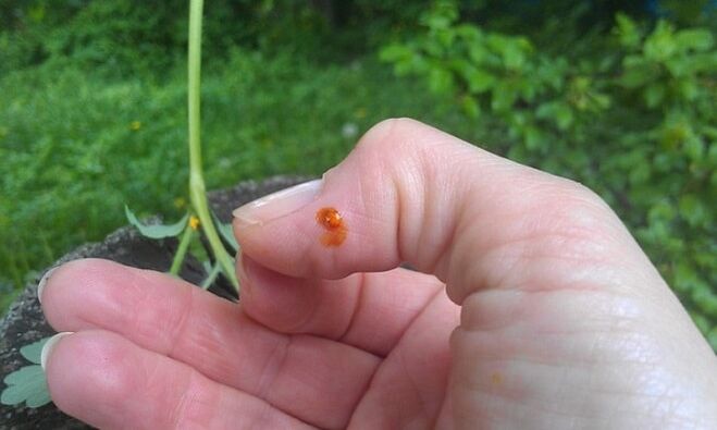 Celandine aplicada ao dedo