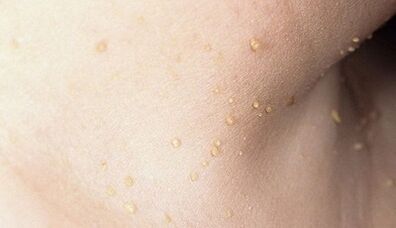 risco de desenvolver papilomatose no pescoço