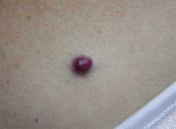 verruga vermelha no corpo