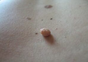 Papiloma é um crescimento na superfície da pele