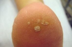Verruga plantar