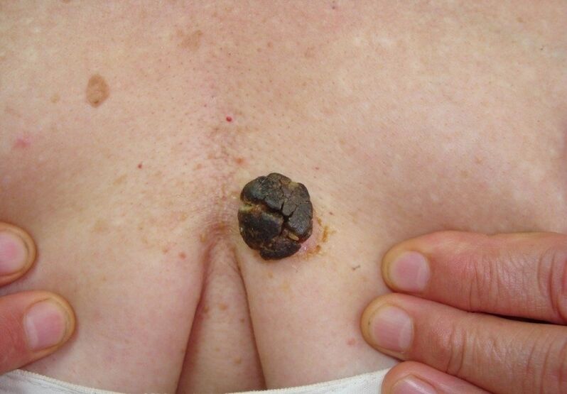 ceratoma no corpo humano