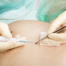 remoção de papiloma por um cirurgião