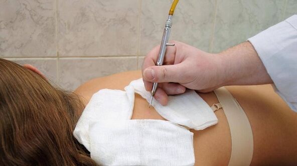 eletrocoagulação de papiloma nas costas