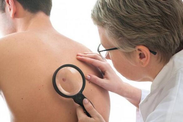 médico examina papiloma nas costas