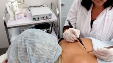 Eletrocoagulação como método de remoção de verrugas